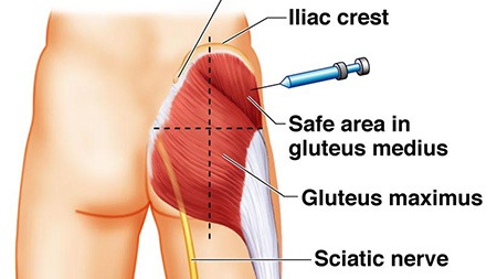 gluteus injection